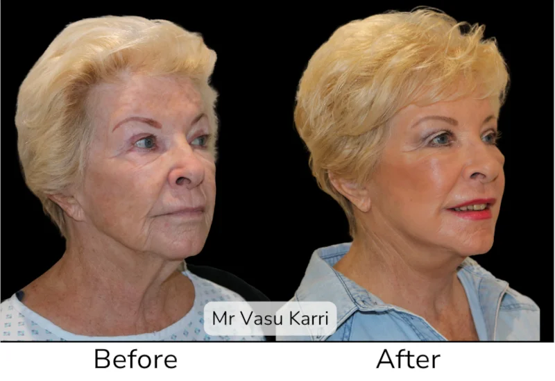 Facelift Patient 5 View 3